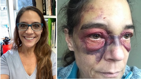 56 year-old Grandmother ends up bruised in Jail after calling 911 for help.