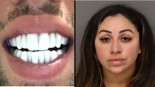 Woman Arrested For Using Nail Glue To Apply Illegal Veneers.