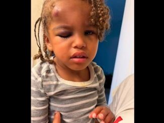 Mom Demands Answers After Son, 3 Leaves Daycare With Knot On His Head.